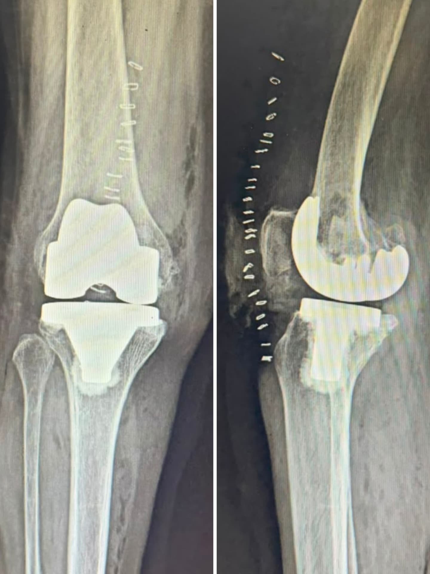 Post-operative X-ray of a total knee replacement
