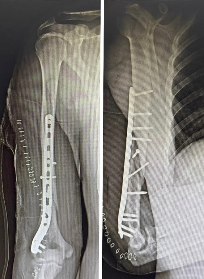 Post-operative X-rays of the arm fixed with a plate