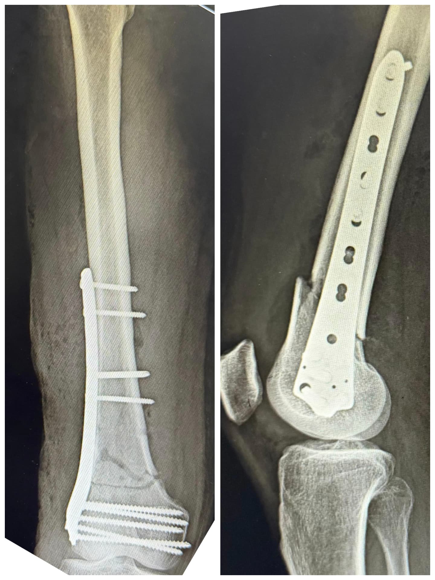 Post-operative X-ray of a lower thigh bone fixed with a plate