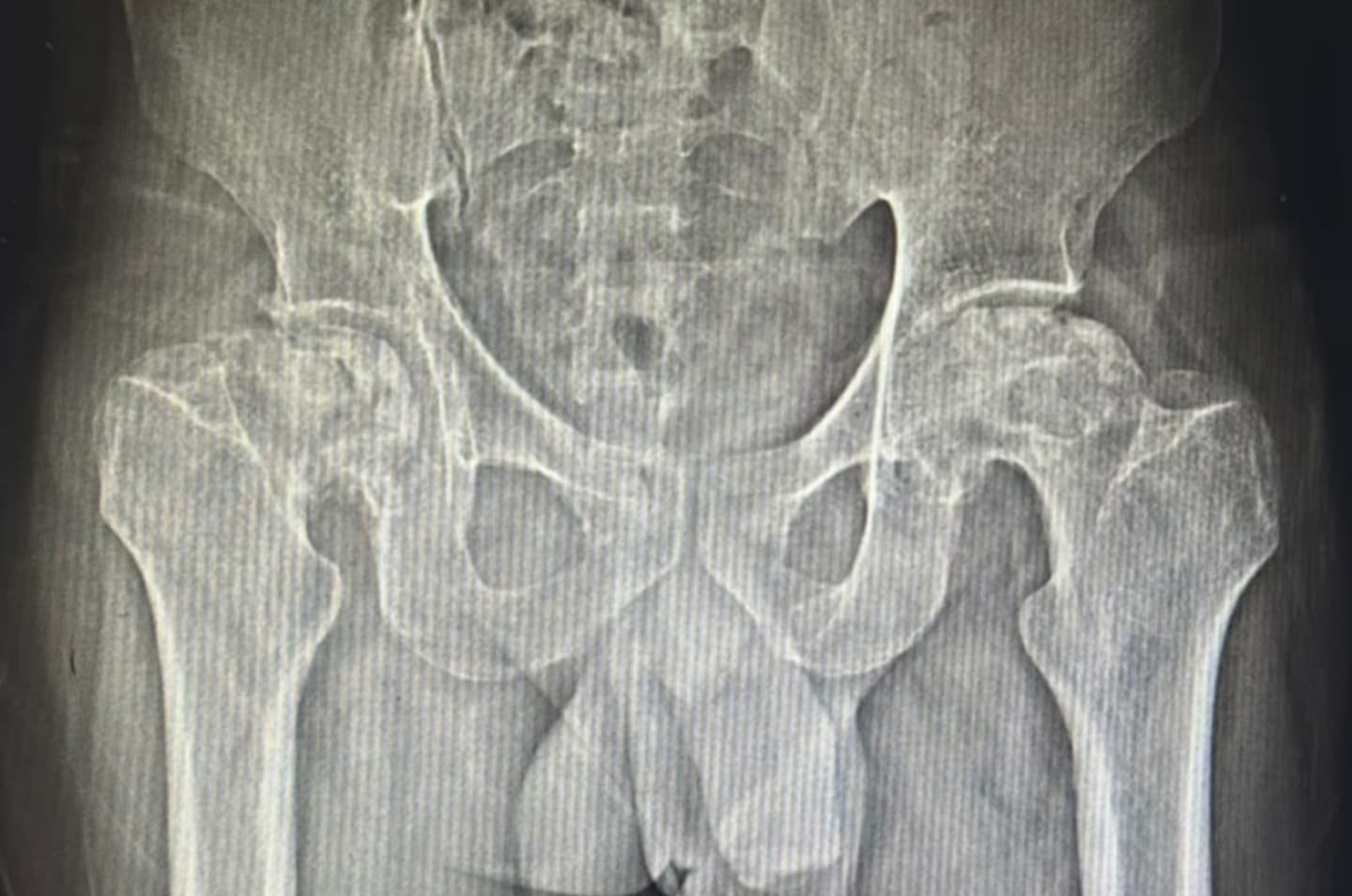 Pre-operative pelvis X-ray showing a damaged right hip