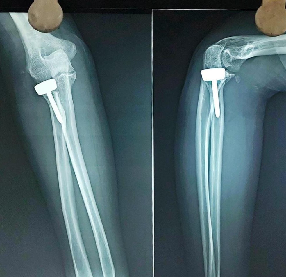 Post-operative X-ray of an elbow radial head implant