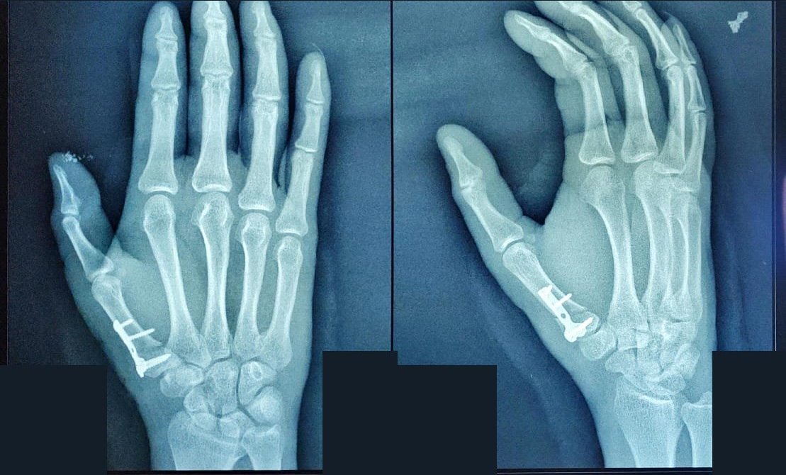 Post-operative X-ray of a thumb bone fixed with a mini plate