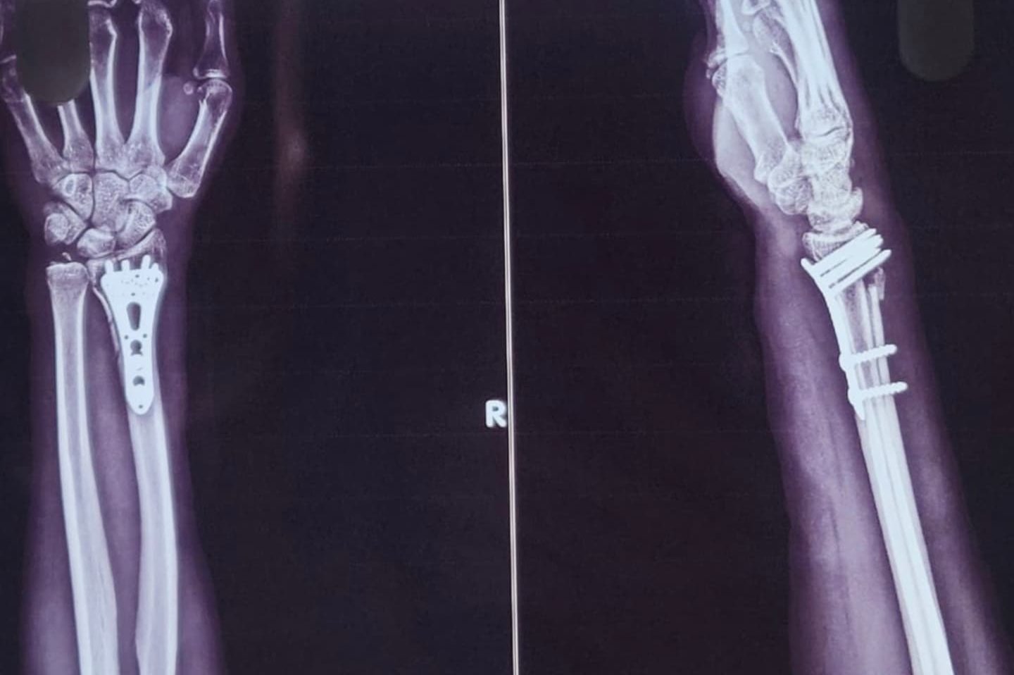 Post-operative X-ray with a plate fixing the wrist