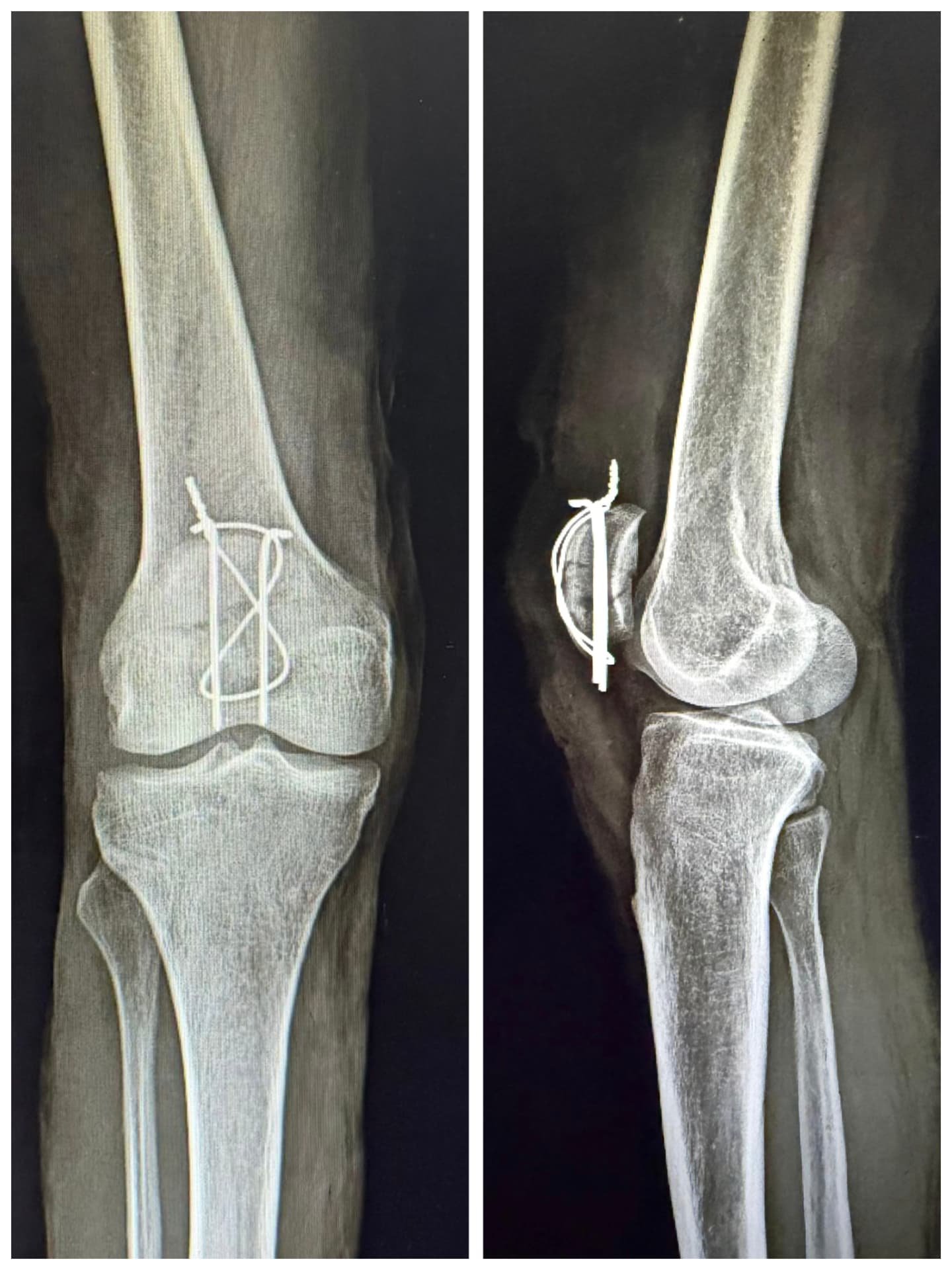 Post-operative X-ray of a kneecap fixed with wires