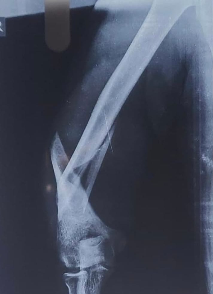 Pre-operative X-ray of a displaced upper arm fracture