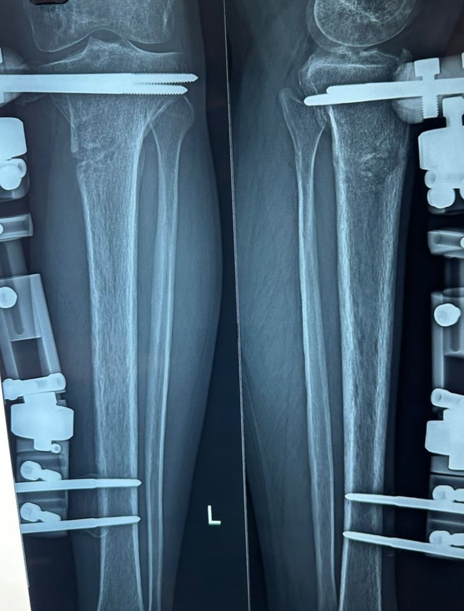 Follow-up X-ray showing the leg healing in an external frame