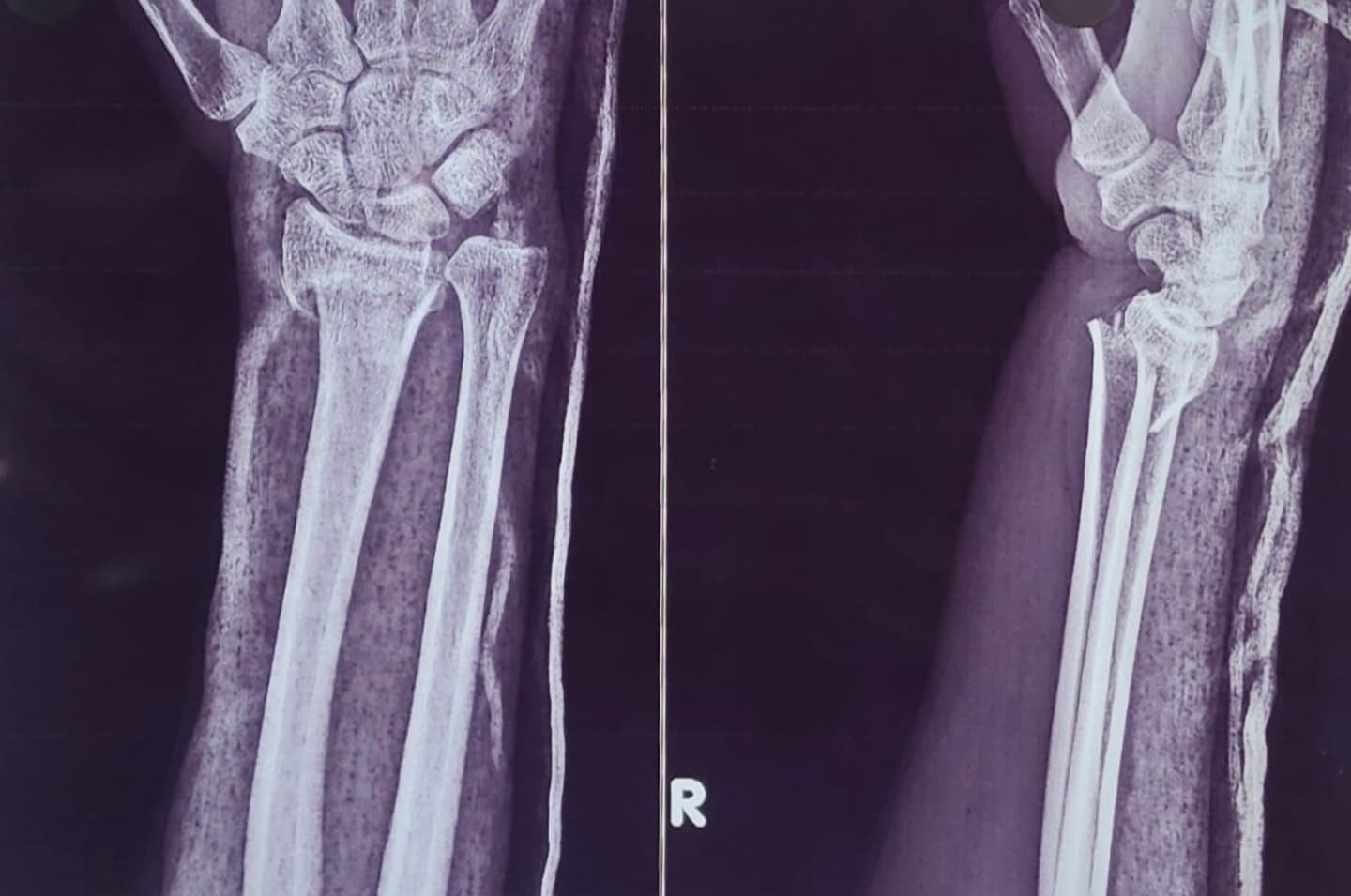 Pre-operative X-ray of a broken wrist