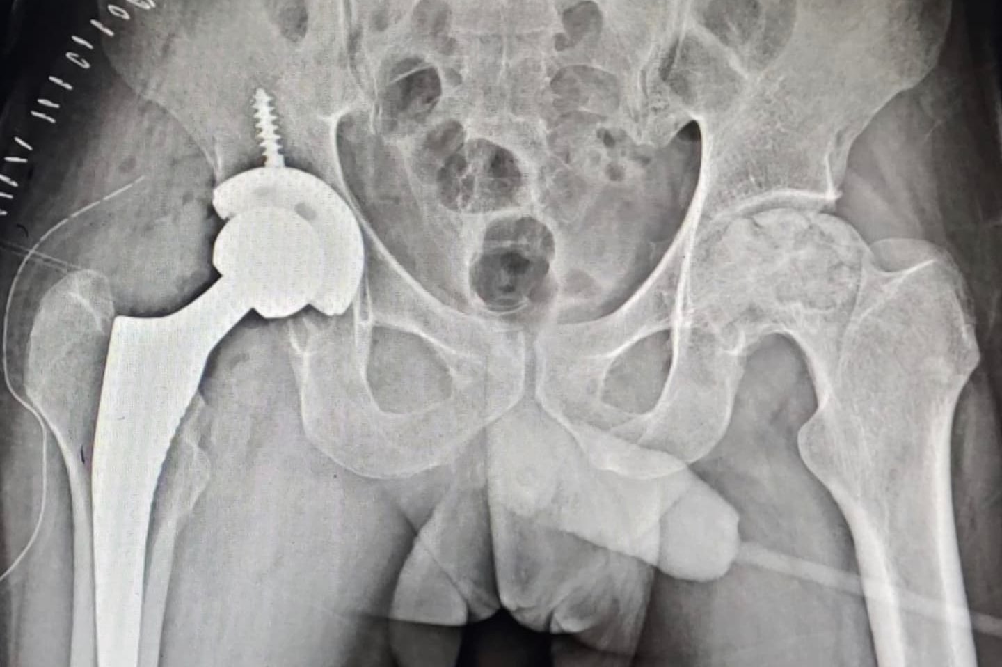 Post-operative X-ray with a hip replacement implant
